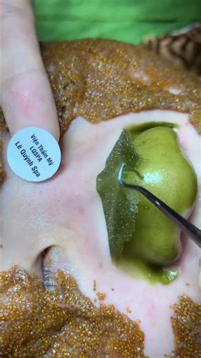 instant Remove whiteheads at home 😱