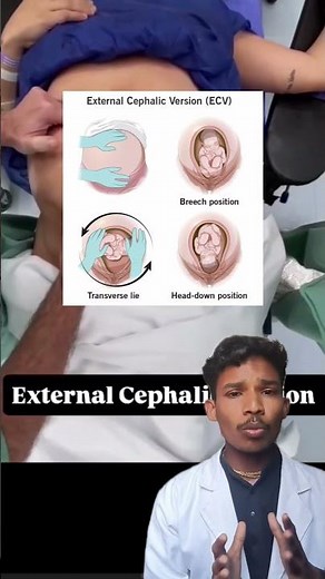 External Cephalic Version