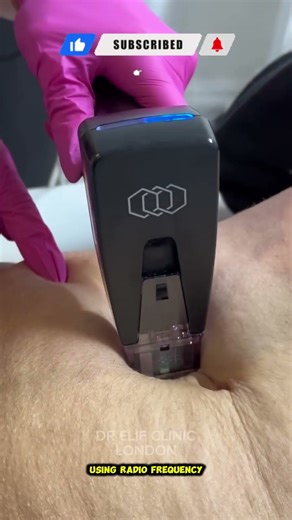 Morpheus8 Abdomen Tightening: Non-Surgical Firming for a Smoother, Defined Stomach #morpheus8