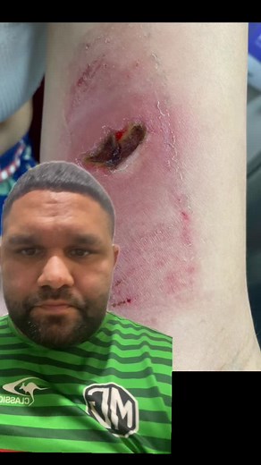 This is the story behind my hot water bottle burn 🔥 told by the man himself 💙@Humdinger2037backup @leabackupacc #FYPPPPPP