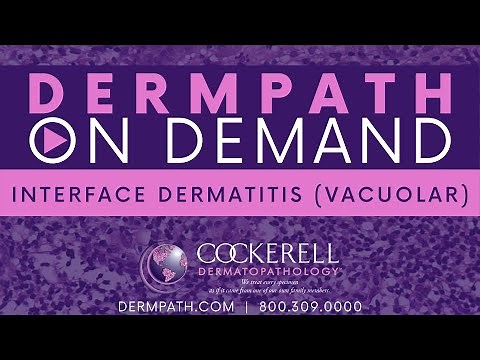 Interface Dermatitis | Vacuolar