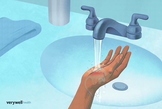 How to Recognize First, Second, and Third-Degree Burns