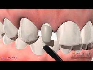 Orthodontic Treatment - Peg Lateral Composite Buildup VS Veneer