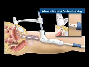 T-SPeC® Illustrated Procedure - English