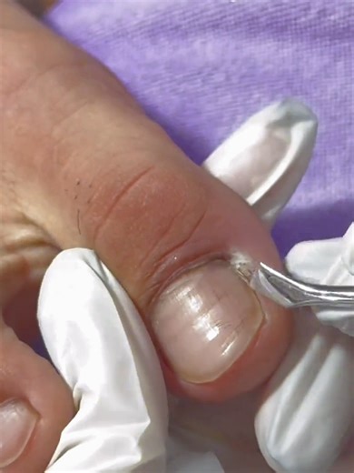 ingrown nail removed from root #ingrowntoenail #footcare#nailtreatment#trending#viral