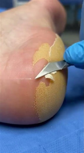 Extreme Close Up Heel Callus Debridement 👣 Satisfying Podiatry Treatment