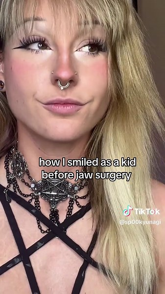 Bunny Rabbit Smile Transformation After Jaw Surgery