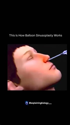 BIOLOGY | MEDICAL | HEALTH ⚕️ on Instagram: "This Is How Balloon Sinusoplasty Works Balloon sinusoplasty is a minimally invasive procedure used to treat chronic sinusitis and blocked sinuses without cutting or removing tissue. A thin catheter with a tiny balloon is guided into the blocked sinus passage using imaging. Once in place, the balloon is gently inflated, which widens the sinus opening and reshapes the surrounding bone. This creates a clear pathway for mucus and fluids to drain naturally
