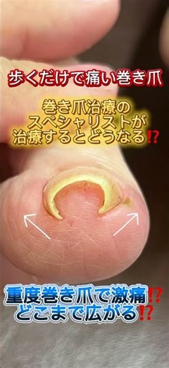 歩くだけで痛い巻き爪！巻き爪治療の天才が治す！#巻き爪 #巻き爪ケア #ネイル #巻き爪治療