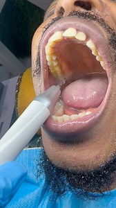 153 reactions · 9 comments | Before and after teeth scaling and...