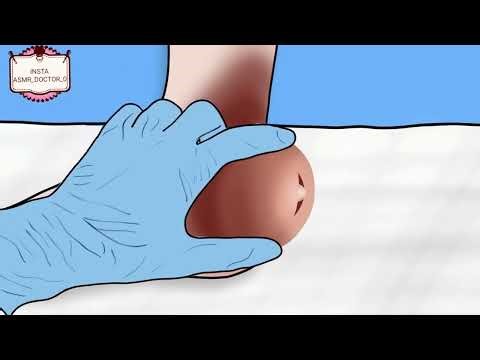 ASMR Remove Cockroach From Rear Foot Cyst Animation