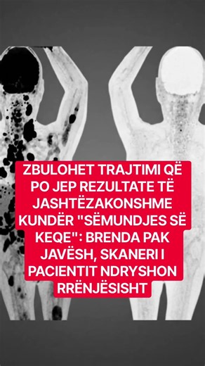 ZBULOHET TRAJTIMI QË PO JEP REZULTATE TË JASHTËZAKONSHME KUNDËR "SËMUNDJES SË KEQE"