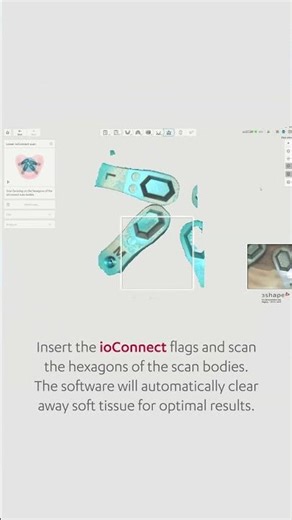You can now do All-on-X cases with dedicated workflows in TRIOS 25.3 software update. #3shape