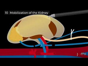 Step by Step : Robotic-Assisted Laparoscopic Left Donor Nephrectomy for Living Kidney Donation