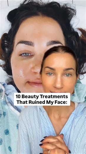Amie Tollefsrud on Instagram: "10 Skin Treatments That Ruined My Face⬇️ (…in the best way) LIKE FOR PART 2! Profound RF Vi peel Dr Diamond insta facial Bbl Xo, Amie #plasticsurgery #skincare #antiaging #botox #filler @drjasondiamond @drdiamondsmetacine @jenn.hollander"