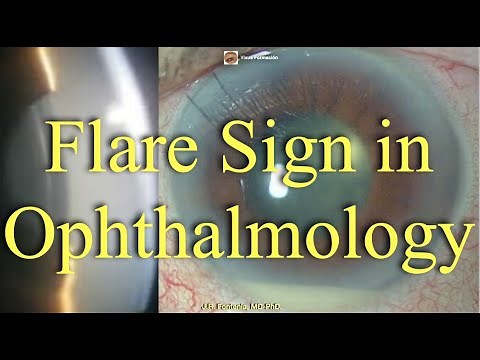 Flare Sign in Ophthalmology. Grading of Intraocular Inflammation.