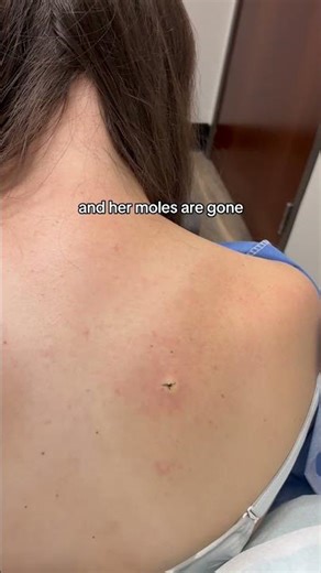 Dermatologist with 50 years experience shows mole removal with hyfrecator 2000 device