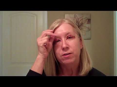 Dallas Upper Eyelid Blepharoplasty Recovery with Dr. Sam Lam
