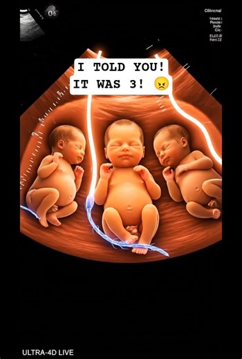 Shocking Triplets Ultrasound Reveal! 😨#babyshorts #babyshorts #asia #fetaldevelopment