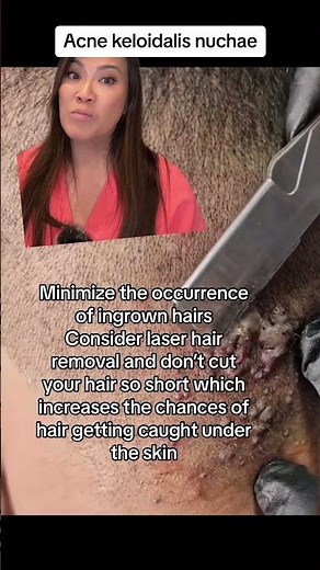 Dr Pimple Popper on Acne Keloidalis