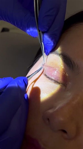 7days post suture removal