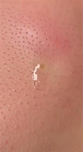 Satisfying Zit Popping Compilation