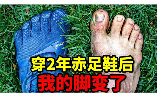 抛弃运动鞋 穿了2年赤足鞋 我的脚变得不一样了｜拇指外翻 拇囊炎 足弓塌陷 扁平足 足底筋膜炎 脚痛｜小腿外翻 x型腿｜足部健康