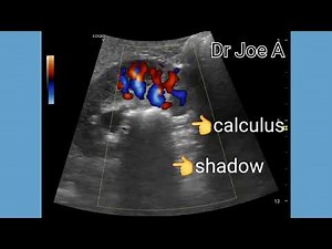 Staghorn calculus right kidney, ultrasound and color Doppler video