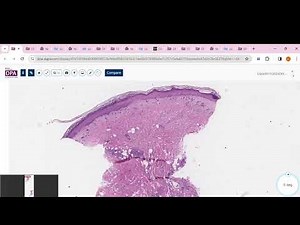 Lipodermatosclerosis