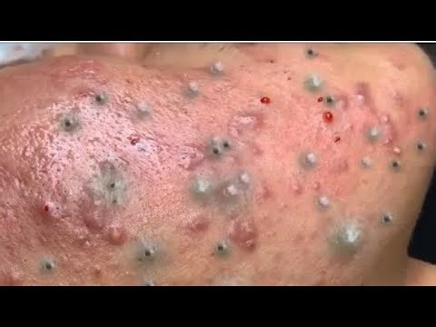 Deep blackhead Removal 2026, acne removal spa, big pimple 2026, #acne #pimple #cyst