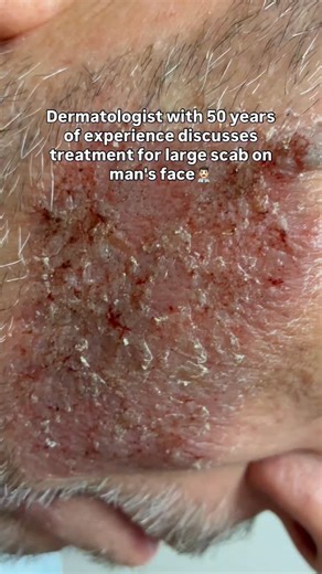 Dermatologist's Choice Skincare on Instagram: "Watch Dr. B share his 50 years of experience as a board certified dermatologist. Part 2 will be posted tomorrow with results after 1 week of patient following this protocol. Follow for more videos of Dr. B. #allergicreactions #dermatology #derm #dermatologist #AllergicReaction Questions answered in this video: • What does an allergic reaction on the face look like? • Can you have an allergic reaction throughout your beard? • What is the best treatme