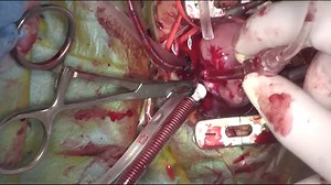Infra-cardiac obstructive total anomalous pulmonary venous return with VSD - rare anomaly
