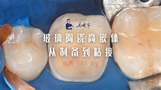 玻璃陶瓷高嵌体从制备到粘接