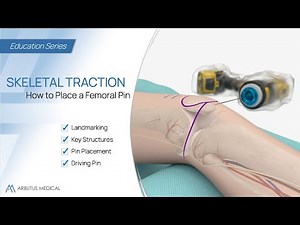 How to Place a Femoral Pin - Skeletal Traction Animation