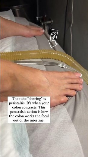 Colon peristalsis during a live colonic irrigation