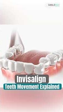 How does Invisalign move your teeth? We simply explain how they gently shift your teeth into place.