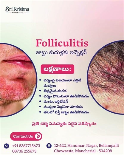 Folliculitis Treatment | Hair Follicle Infection Care | Sri Krishna Hospital Mancherial