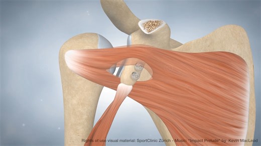 Animation Latarjet procedure