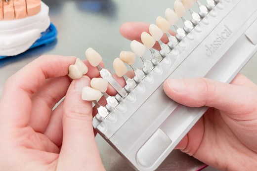 Facette dentaire : pose, prix, avant/après, durée de vie