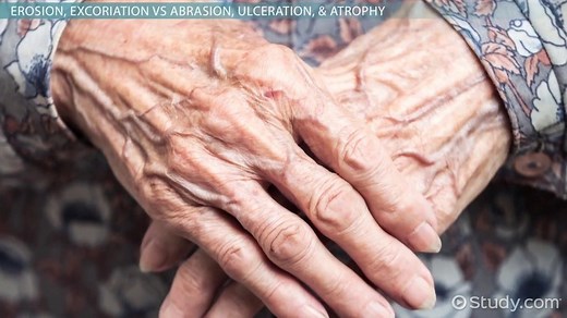 Secondary Skin Lesions | Overview & Types