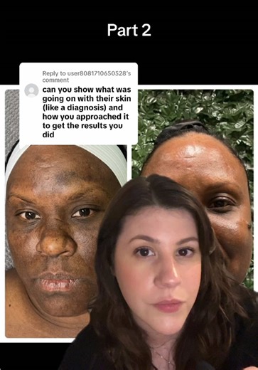 Treatment Protocol for Hyperpigmentation Explained