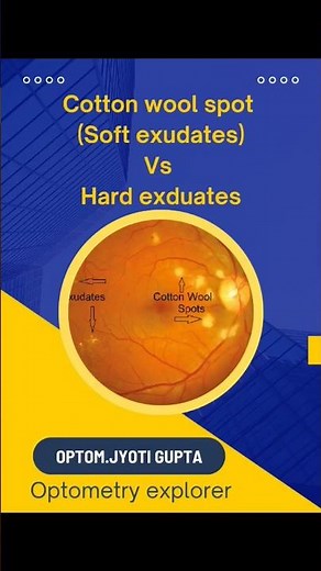 Cotton wool spot(soft exduates) Vs Hard exduates.#clinical #retina