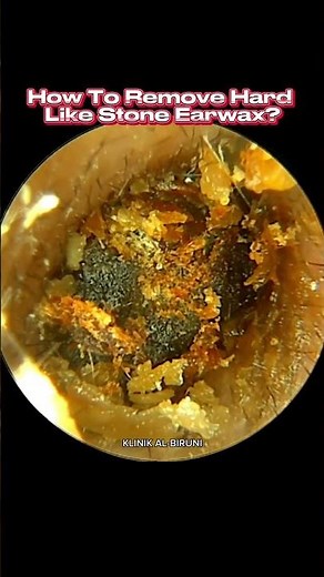 HOW TO REMOVE HARD LIKE STONE EARWAX? (4K 60FPS)
