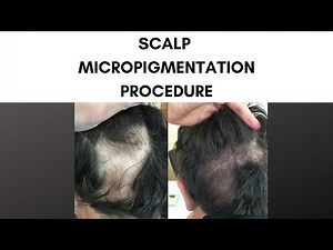 Scalp Micropigmentation Procedure at Parsa Mohebi Hair Restoration