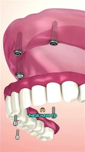 Types of Dentures