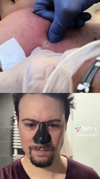 Percement du Plus Gros Bouton : Réaction Incroyable !