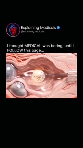 Medical | Health | Anatomy on Instagram: "This Is How IVF (In Vitro Fertilization) Works Inside the Lab IVF, or In Vitro Fertilization, is a medical process where fertilization happens outside the human body under carefully controlled laboratory conditions. It begins with hormonal stimulation to help the ovaries produce multiple mature eggs, which are then retrieved using a minimally invasive procedure. In the lab, these eggs are placed in a sterile culture dish and combined with prepared sperm,
