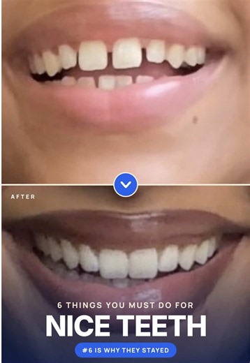 Full video on my YouTube❤️ Your smile is one of the FIRST things people notice when they meet you. 😁 I created my Skool community for like minded individuals who want to look and feel better because remember, there’s always room for improvement! Link in bio 🦷💌 #glowup #fyp