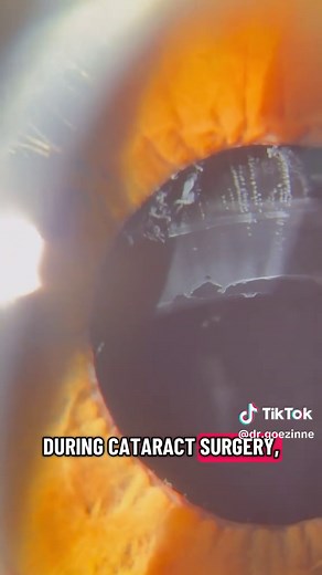 Understanding Pseudoexfoliation and Its Impact on Cataract Surgery