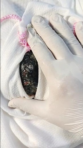 "Real Life Surgery Case | Rare Medical Condition Explained | Doctor's Live Procedure"#baby #cutebaby